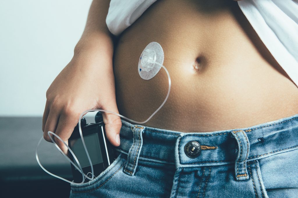 Type 2 Diabetes: Science-Backed Natural Treatments for Diabetes | natural treatments for diabetes the abdomen of a diabetic child with an insulin pump dressing connected in his abdomen natural treatments for diabetes - the abdomen of a diabetic child with an insulin pump dressing connected in his abdomen