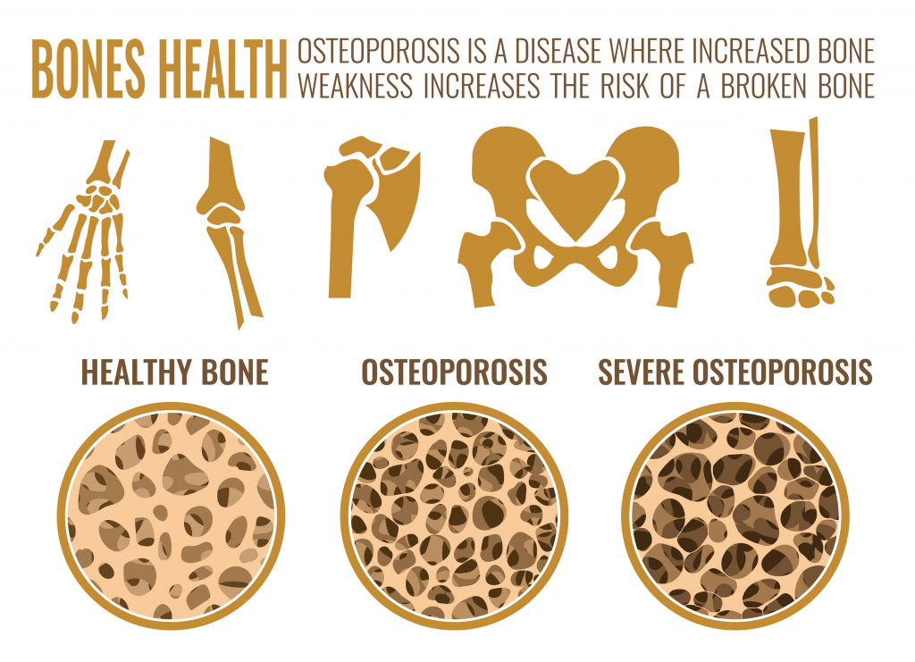 Can Osteoporosis Be Reversed - images of bones in different states